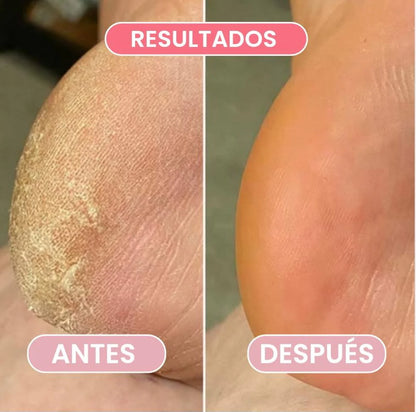 Removedor de Callos eléctrico  - Pies Suaves